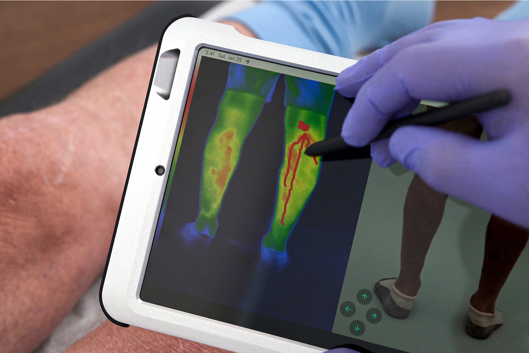 vein mapping ultrasound