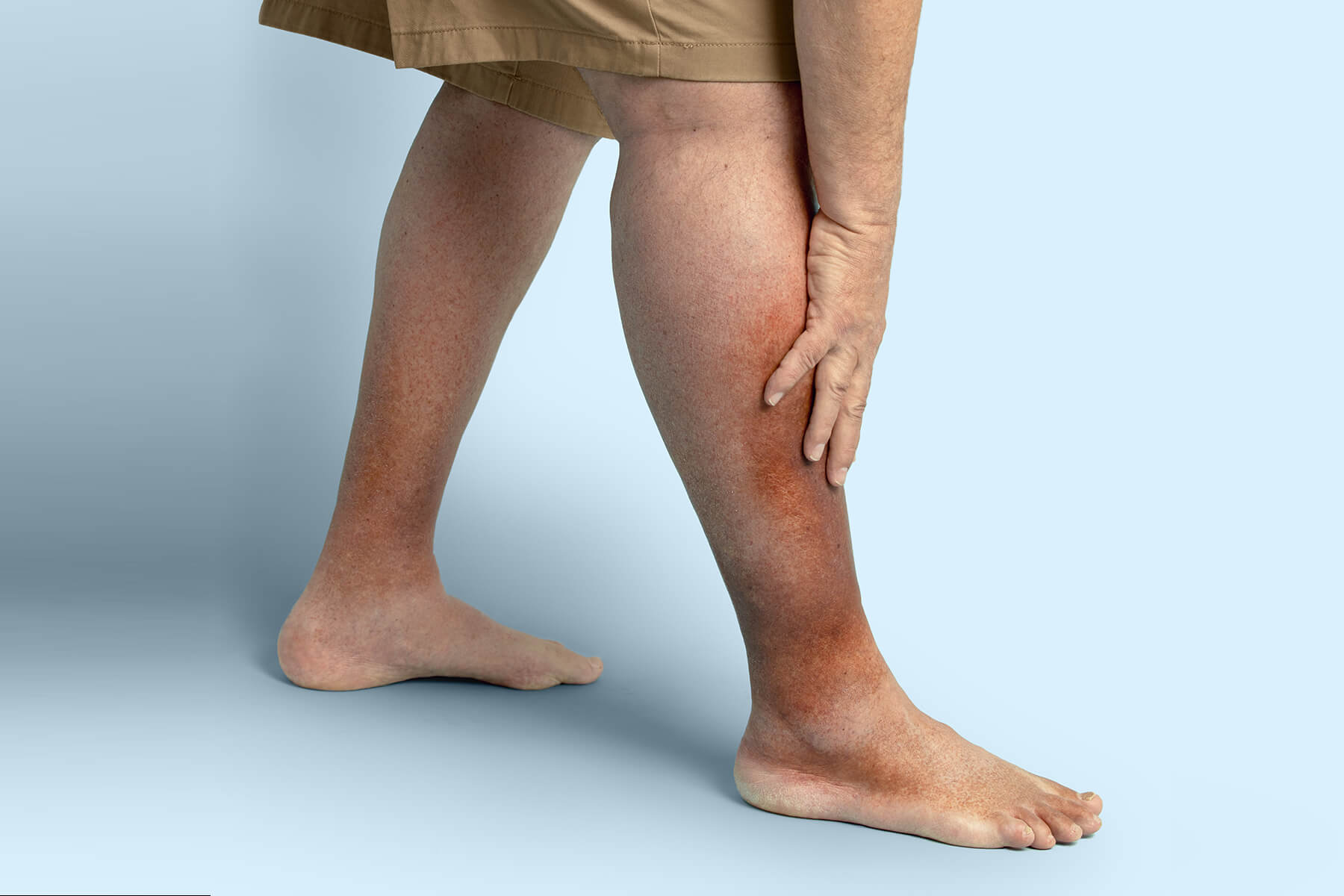 Skin Darkening