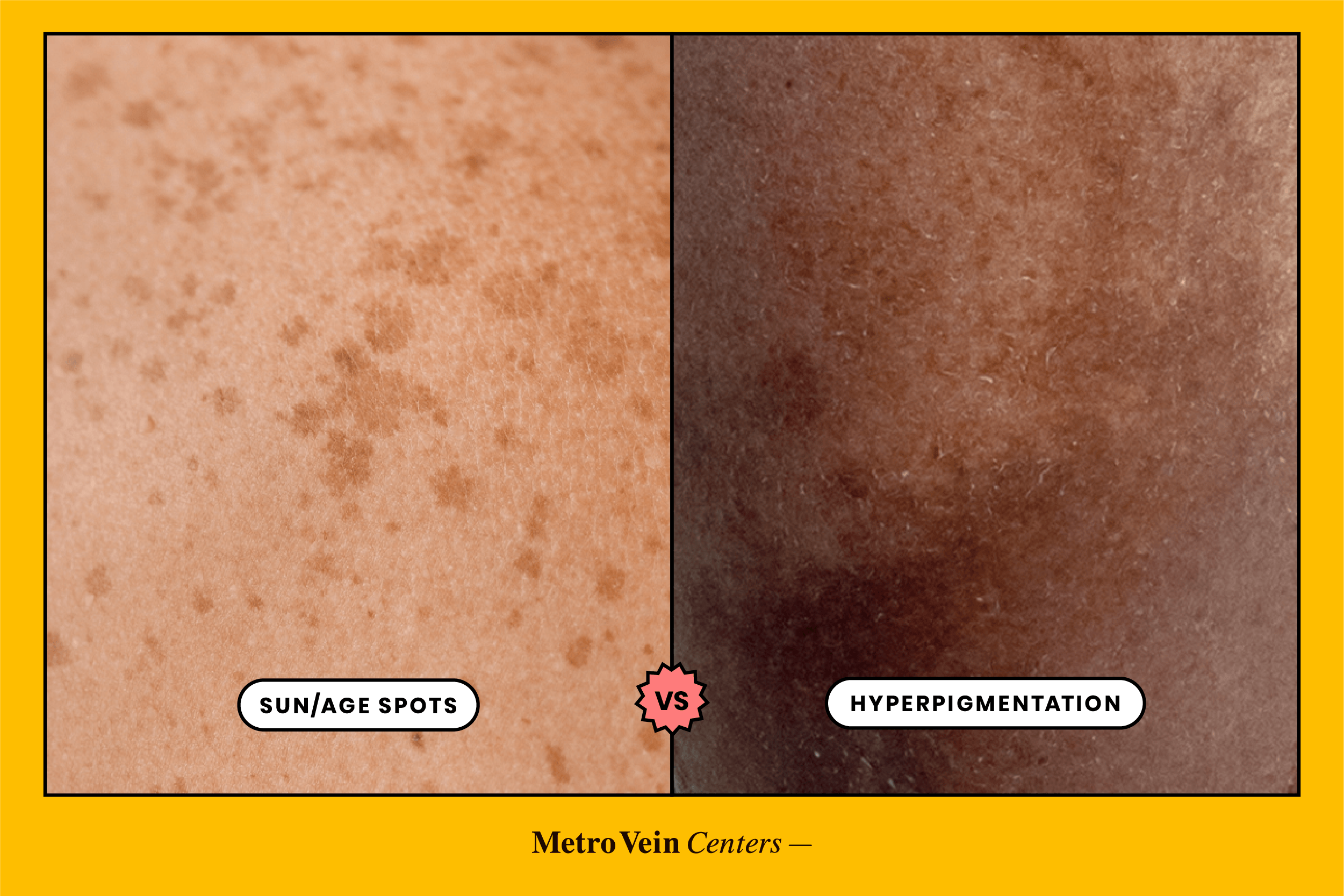 Venous Hyperpigmentation vs. Sun Damage