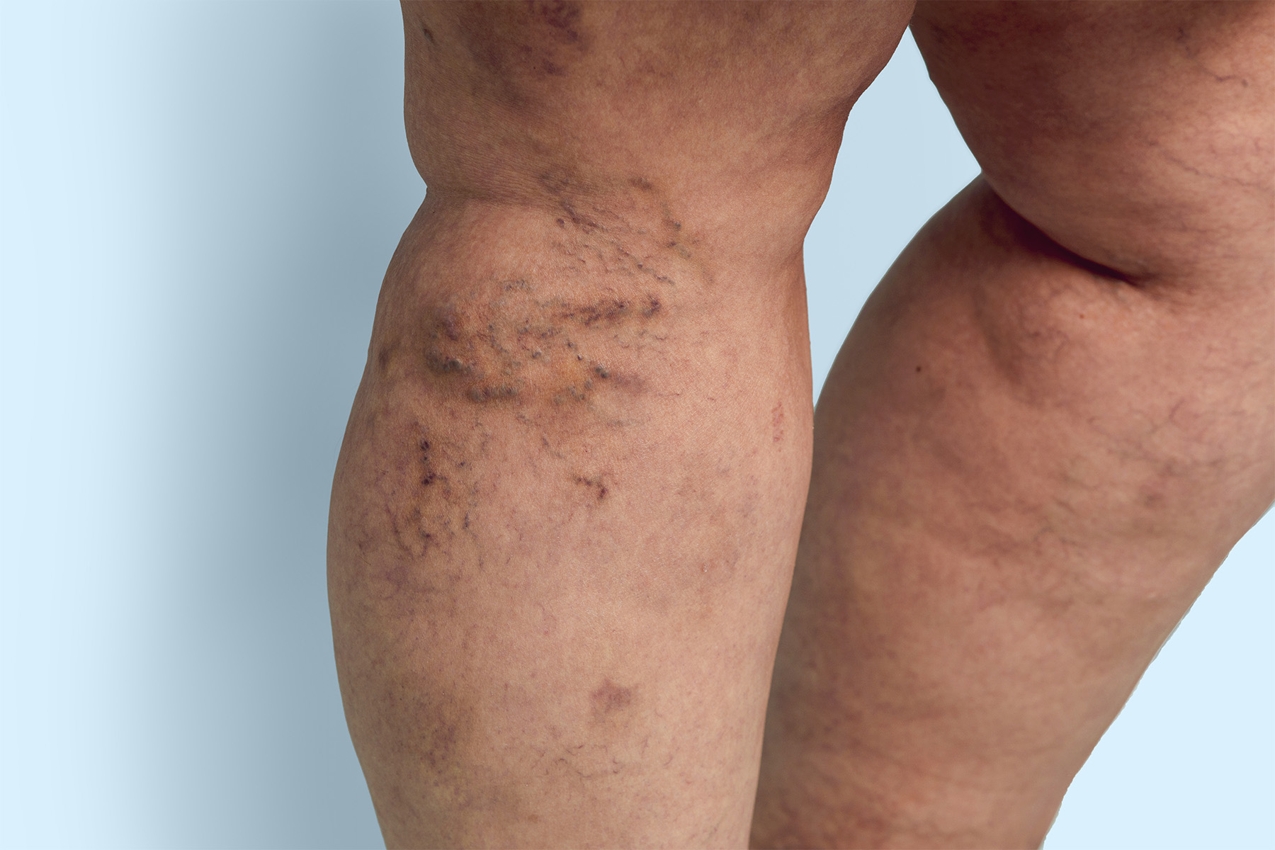 Discover expert tips for maintaining healthy leg veins, preventing varicose veins, and treatment options specifically designed for women&rsquo;s vascular health needs.