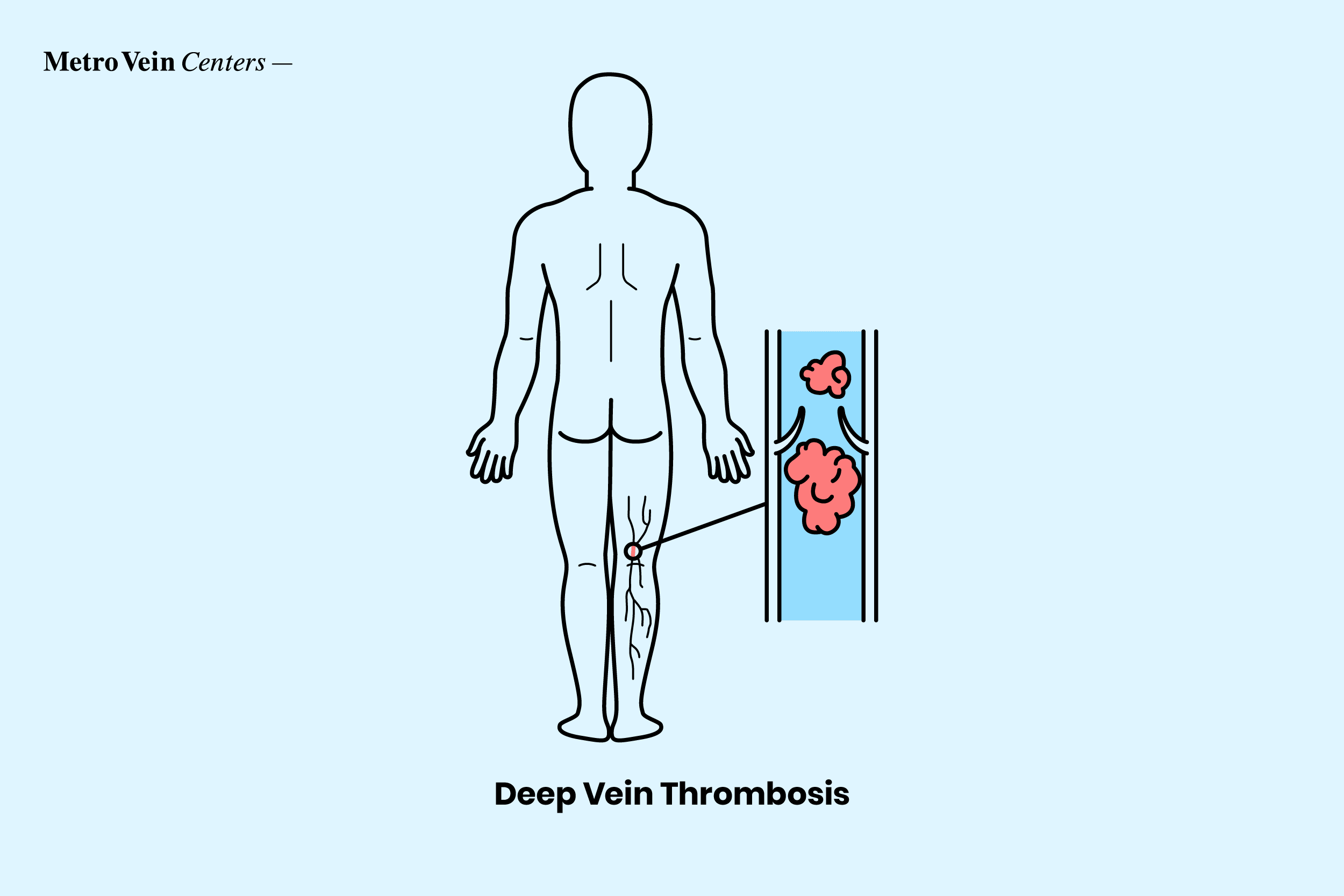 DVT