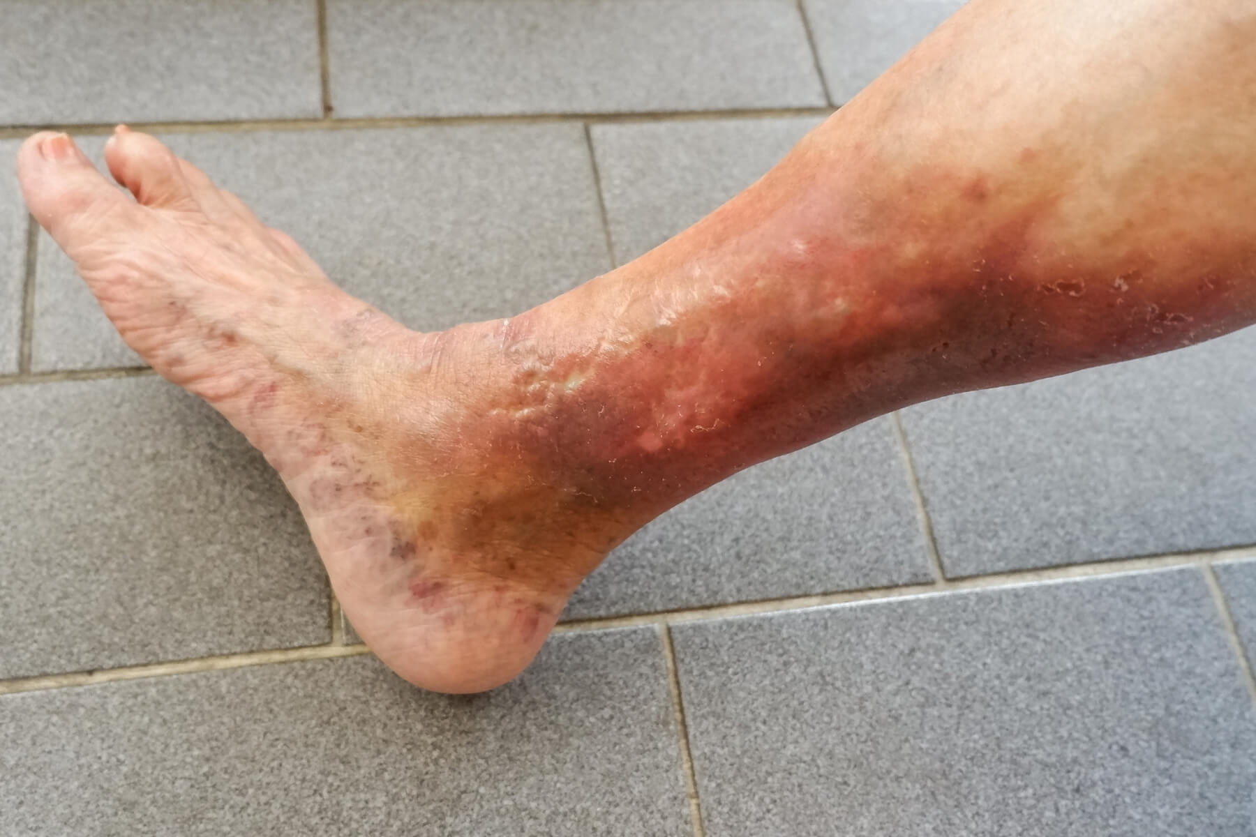 venous ulcers