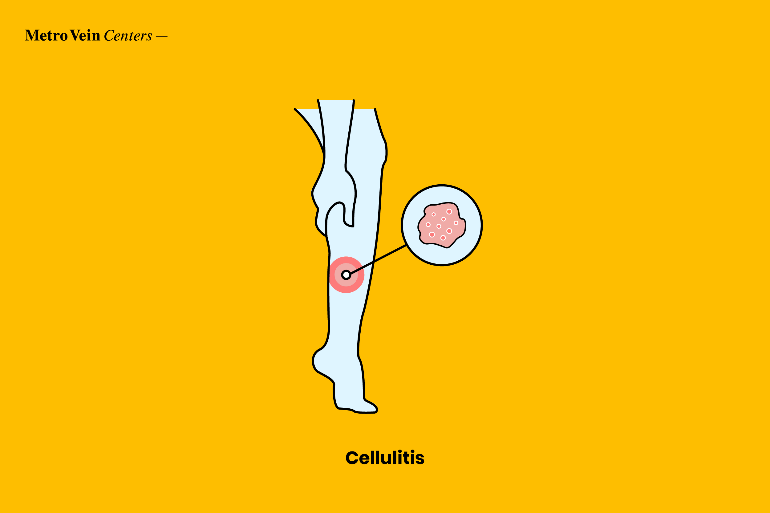 cellulitis
