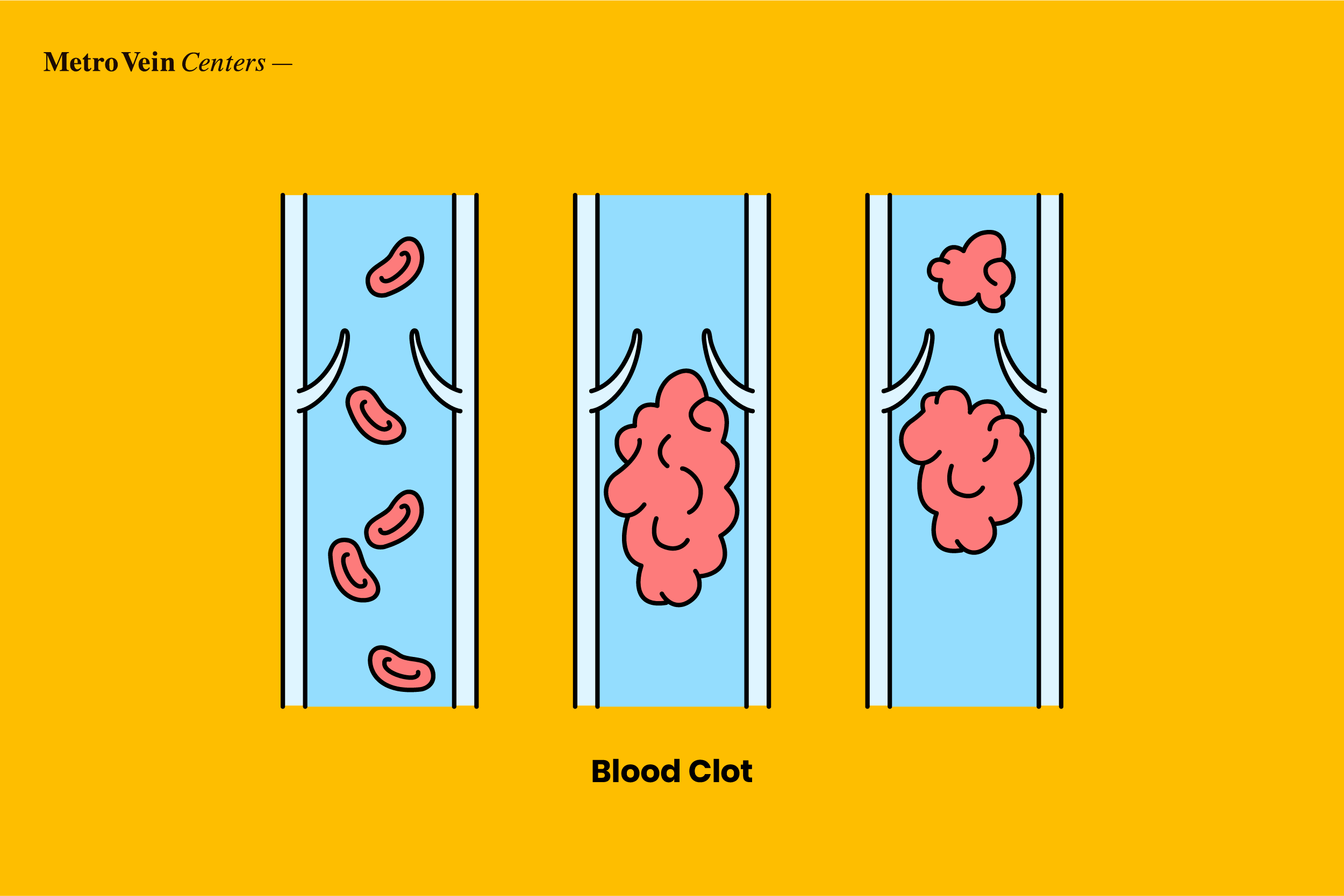 blood clots