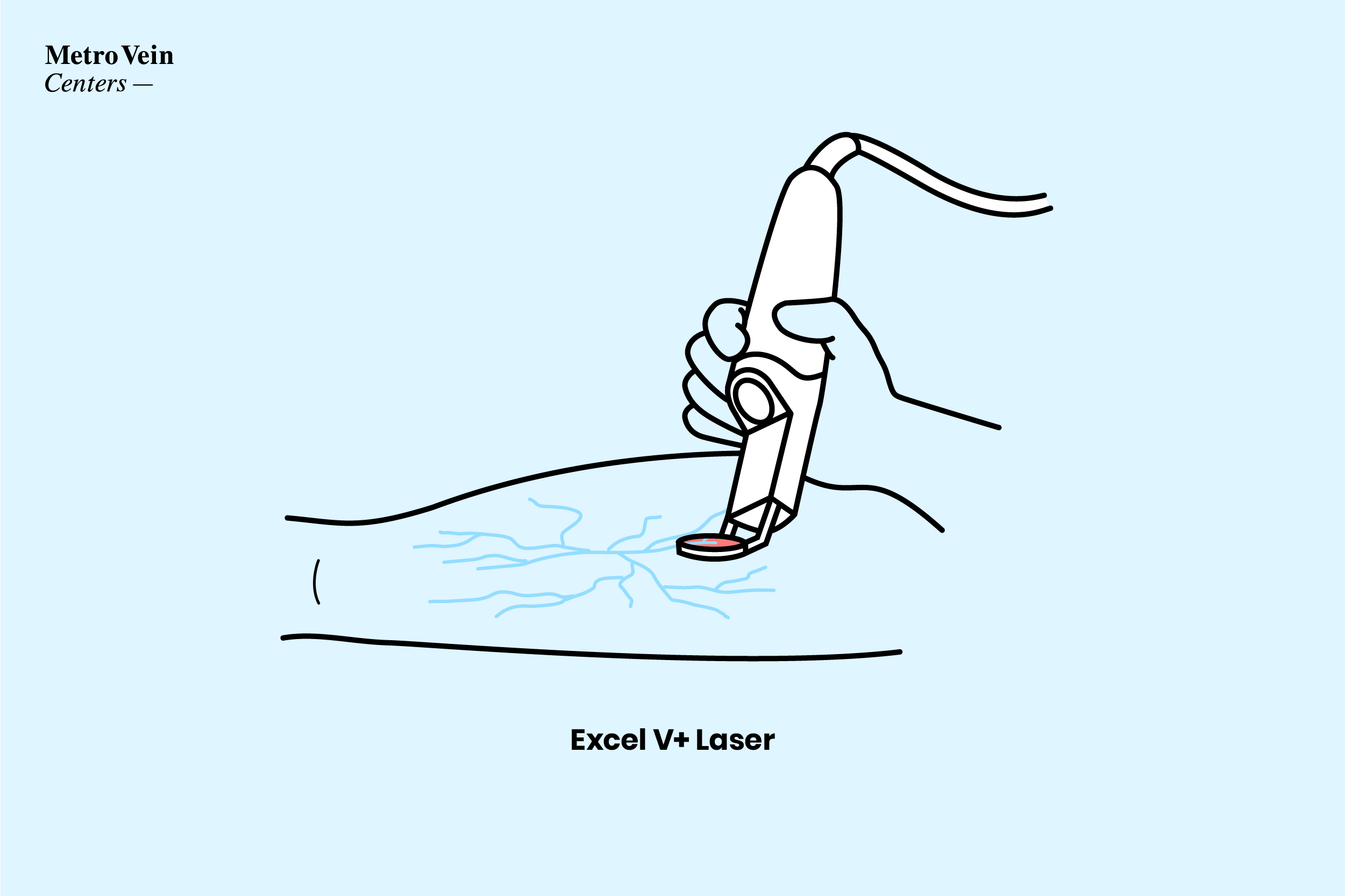 excel v+ laser