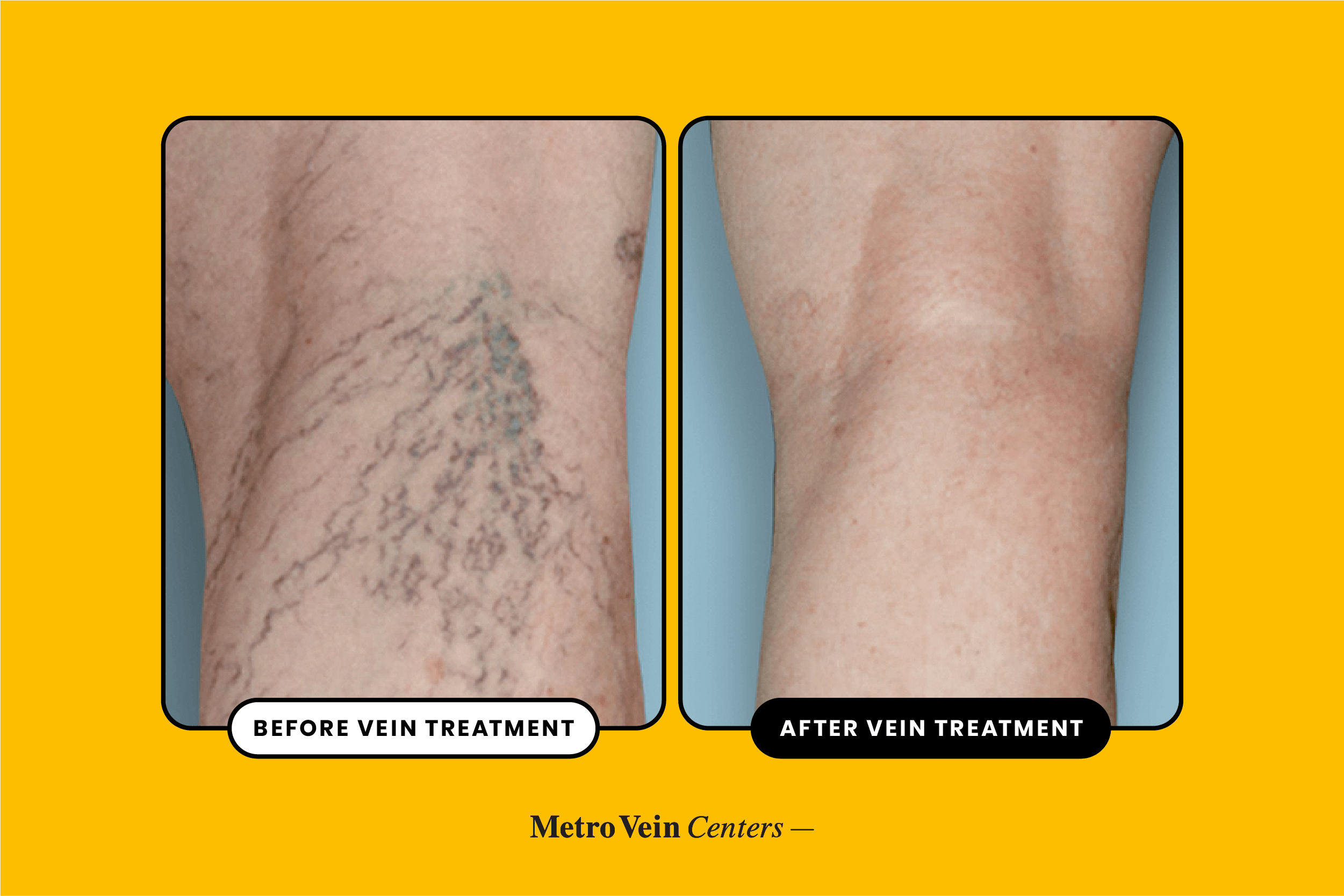 spider vein before and after