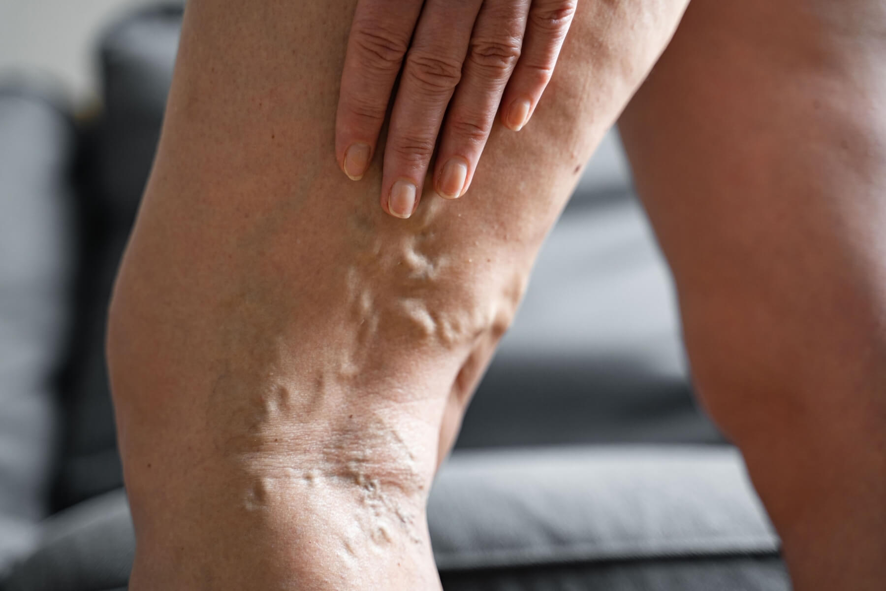 varicose veins