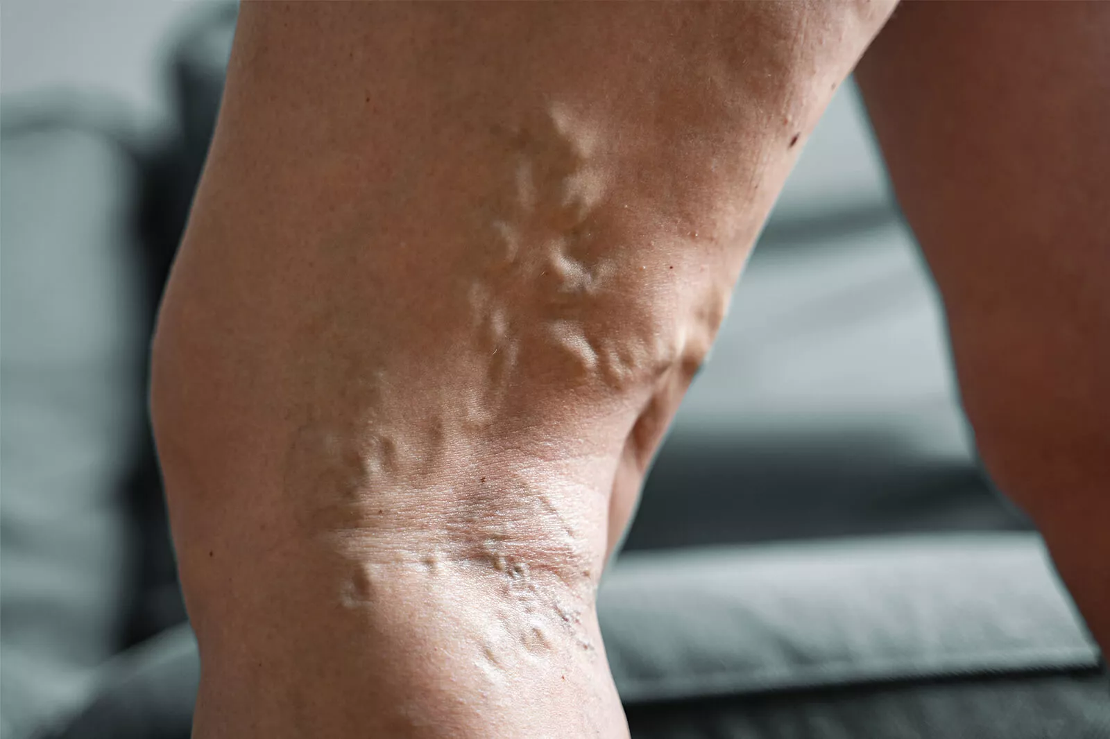 Explore venous reflux disease, its causes, symptoms, and treatment options. Learn how to manage this condition for healthier, pain-free legs.
