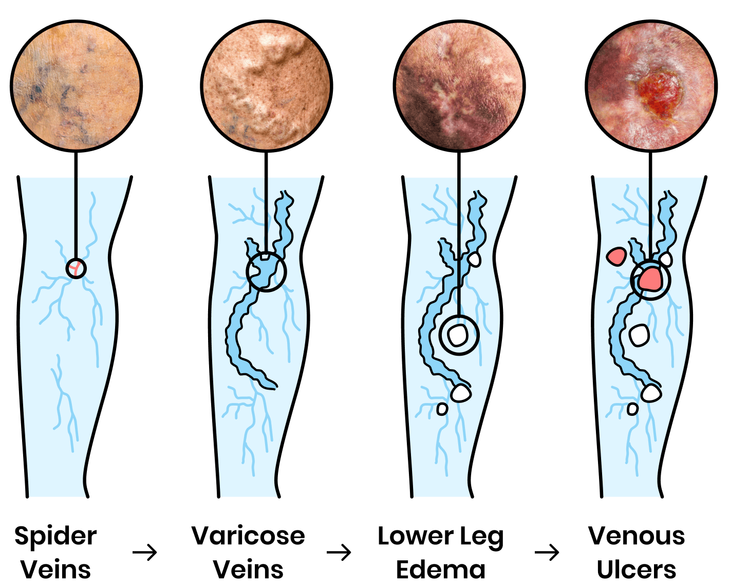 Did You Know Vein Disease is Progressive?