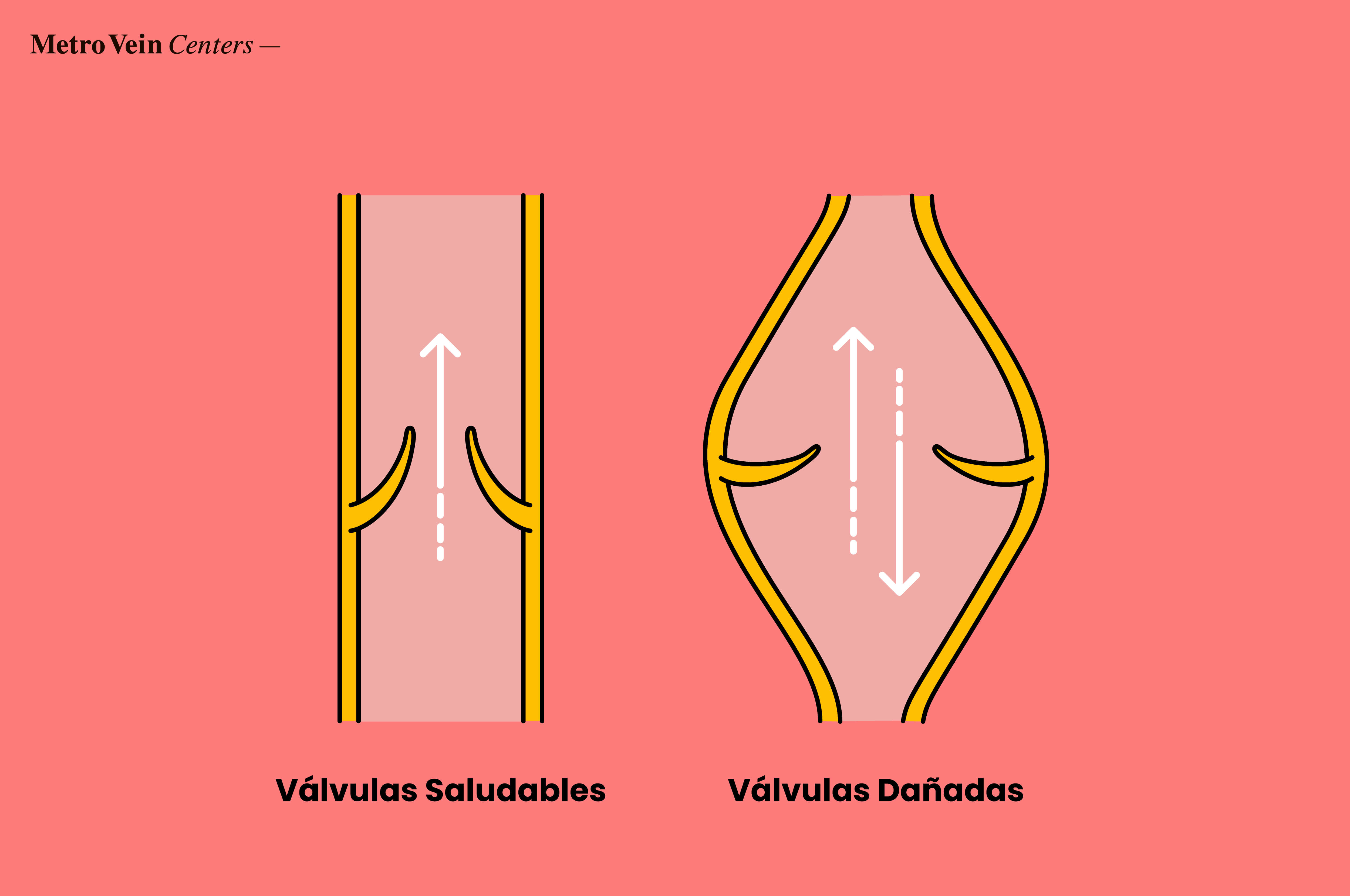 Flujo sangu&iacute;neo en venas sanas vs. venas da&ntilde;adas con insuficiencia venosa