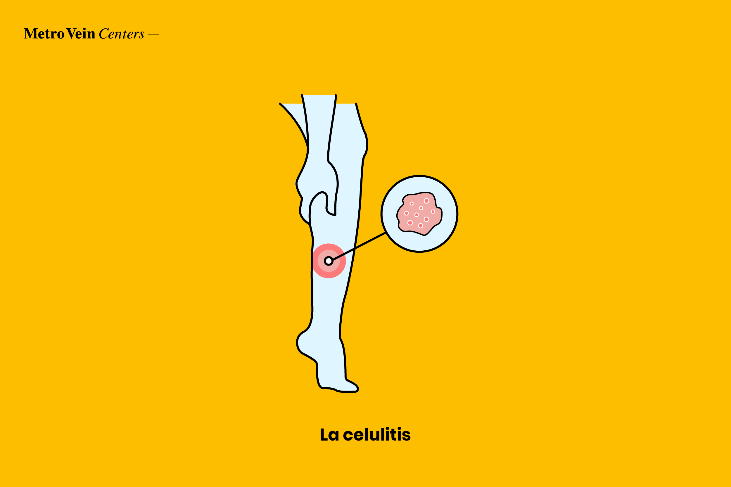 la celulitis